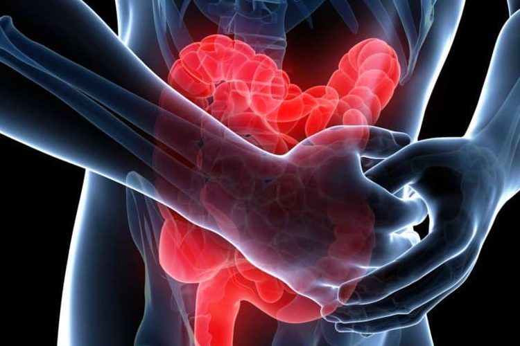 Inflamación intestino sintomas